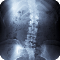 scoliosis chiropractor near me